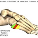 발등(제5중족골 근위부) 피로 골절 - 피로 골절이란 무엇인가?? 이미지