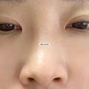 테스코 | 서면역피부과 부산 테스코 후기, 자보실 코실리프팅 효과
