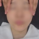 신사피부과 고우리 효과 후기, 꺼진 앞볼 고민으로 받아본 솔직 후기