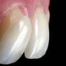 가온치과기공소 | 라미네이트 장단점 | 결정 전에 불편한 진실도 알아야 합니다[신곡동치과]