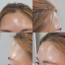 삼성성모의원 | *삼성성모의원 필러 후기