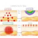온다 리프팅은 왜 아프지 않을까요? (온다 리프팅은 통증이 없을 뿐 아니라, 여러 가지 면에서 효과적인...