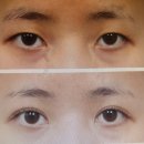 프렌즈성형외과의원 | 강남 눈성형잘하는곳,트임전문 내 돈내산 찐후기 신논현 시선성형외과