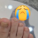 웰니스클리닉(청계천점) | 레푸스 청계천점 문제성발톱 케어 (발톱 사마귀, 레푸스 비용 가격 정리)