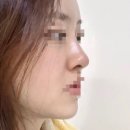[서울/강남] 내돈내산 노즈빔 2주차 후기 + 비공내리기까지
