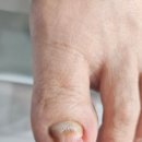 내일도;네일해 | 대구 내성발톱 내일도네일해에서 발 상태를 꼼꼼하게 살펴본 후기