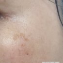 (주)우신라보타치 | 우신 라보타치의 다크스팟케어패치 후기 -중년여성의 고민 기미잡티