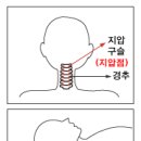 목디스크 "신경의 눌림에 의한 증상" 이미지