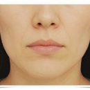 아이웰빙의원 | 문정 피부과 슈링크, 후기만 보면 안되는 이유