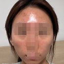 나봄에스테틱 | 약초필 효과, 증상 및 경과 내돈내산 후기
