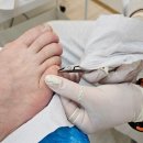 수원-1590 | 수원 영통 발톱무좀 관리, 레푸스 수원영통점 발톱 스케일링 후기(위생 멸균까지)