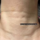 다나을의원 | 청담동 피부과, 디어넥 콜라겐주사 부작용 효과 유지기간 선천적 목주름 내돈내산 리얼후기 3회차 최종