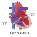 방실 중격 결손[Atrioventricular septal defect] 소아청소년질환, 순환기질환 이미지