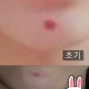 모낭염 흉터 없애는법(노스카나겔, 시카케어, 씨에스랩)