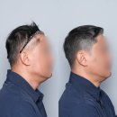 [공지] [용인두피문신]용인 탈모커버 두피문신 후기, 밀도감과 디자인 만족