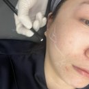 프라임 | 강남 울쎄라프라임 리프팅 효과 및 가격 솔직후기