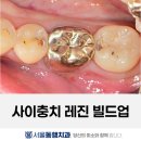 서울대학교직장부속치과의원 | 치아 사이 충치를 레진 빌드업으로 치료한 케이스 | 대구 수성구 서울동행치과의원