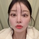 윤의원 | 얼굴 탱탱하게 쫙 펴진 시술 추천 진짜 솔직한 시술후기경험담!! 광고 절대 X 리프팅,스킨부스터,보톡스...