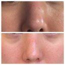 강남-147 | [강남] 강남 압구정 기미 잡티 제거 후기｜미작뷰티 강남 본점 제로스팟 듀오덤 관리, 제로스팟 리얼...