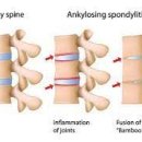 강직성 척추염[ankylosing spondylitis] 이미지