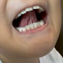 베스트이비인후과의원 | 광주 8살 설소대시술 &#39;베스트이비인후과&#39; 후기