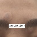하얀나라김피부과 네이버블로그