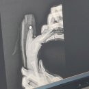 동진의료기 | [퇴원 후]실밥&amp;철심 제거 및 보조기 제작