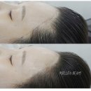 수헤어라인 이미지