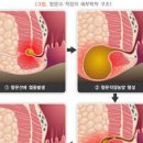 항문 농양 증상 및 원인과 수술 이미지