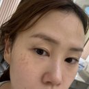 루비약국 | 루비레이저 후천성 오타모반 후기 가격 효과