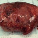 Cardiopulmonary Bypass to Facilitate Excision of a Giant Pleural Tumour 이미지