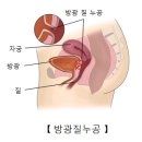 비뇨기 질환 이미지