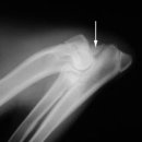 anconeal process that has been separated from the rest of the ulna(척골) 이미지