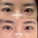 디자인스킨부산역사점 | 부산 고우리스킨부스터 연산동피부과에서 눈밑 붓기 통증 후기