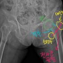 [행복대학] 100세 건강을 위한 행복 걷기 | 90세, 100세의 고령인데도 고관절 골절 수술을 해야 할까요? – 103세 고관절 골절 수술 케이스