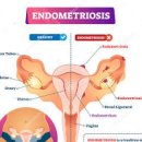자궁내막증 증상 원인 (생리통증상 골반통증 임신) 이미지