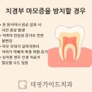 태평가이드치과의원 | 태평역 치경부 마모증, 단순히 칫솔질 때문만은 아닙니다. 치과에서 검진받아보세요.(치료사례)