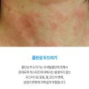 질병 "두드러기urticaria " 이미지