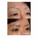 아이댄디안경 | 엄마 눈처짐 수술 6일차 후기 눈썹하거상+절개 전후 차이 대박임;