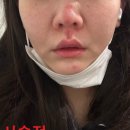 쁘띠치과의원 | [내돈내산] 찰과상 흉터치료 후기(브이빔레이저)