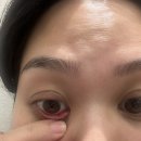 엠에스메디칼 | 34주차 임산부 임산부 다래끼국소마취후기