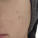 은하메디 | 셀프 피부관리 리들샷 100 사용법 효과 콜라겐팩 조합 부작용 2주 솔직후기