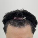 O:Na(오나) | [ 모발 이식 후 부족한 밀도감 ] 일산 두피문신 'O.NA SMP'로 꽉 찬 헤어라인 완성하기