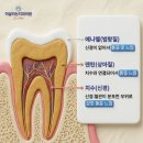 디메넥스 치과기공소 | 라미네이트 장단점과 부작용은?