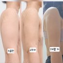 (주) 나유 | 내돈내산 청담 르로제의원 팔뚝 지방흡입 한달차 후기