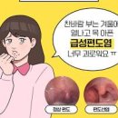 목감기 초기증상 목감기빨리낫는법 침삼킬때 목아픔 이미지