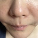 바디부스터짐 | 기미·검버섯 없애기 프로젝트 4번째 큐어젯 쥬베룩 백옥바디부스터 후기 및 통증 다운타임 후기