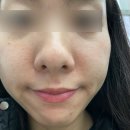 메디컬오한의원 | [인천] 메디컬오한의원 송도점 모공리액터 20회차 내돈내산 후기