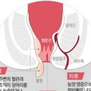 대변에 피 혈변 보인다면 원인 이미지