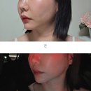 미라클의원 | 내돈내산 실리프팅 당일후기 : 압구정미라클의원